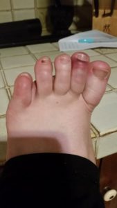 worrier broken toe